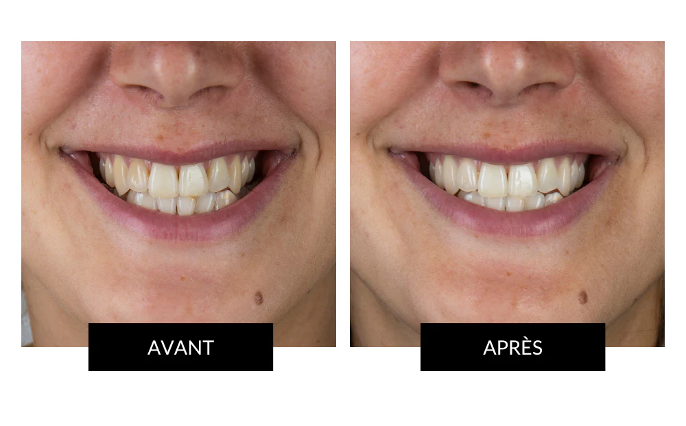 CurrentBody Skin - Kit de Blanchiment des dents LED Offre - Image 2