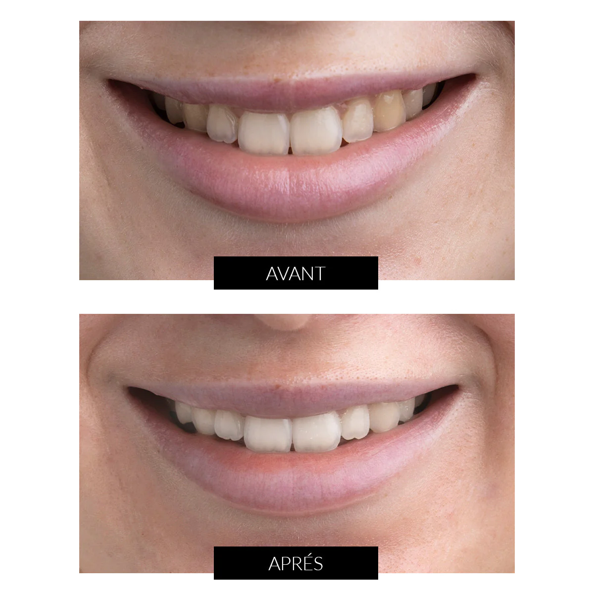 CurrentBody Skin - Kit de Blanchiment des dents LED Offre - Image 3